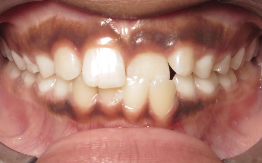 More smile transformations 168 Smile transformation before orthodontic treatment j shepherd center start