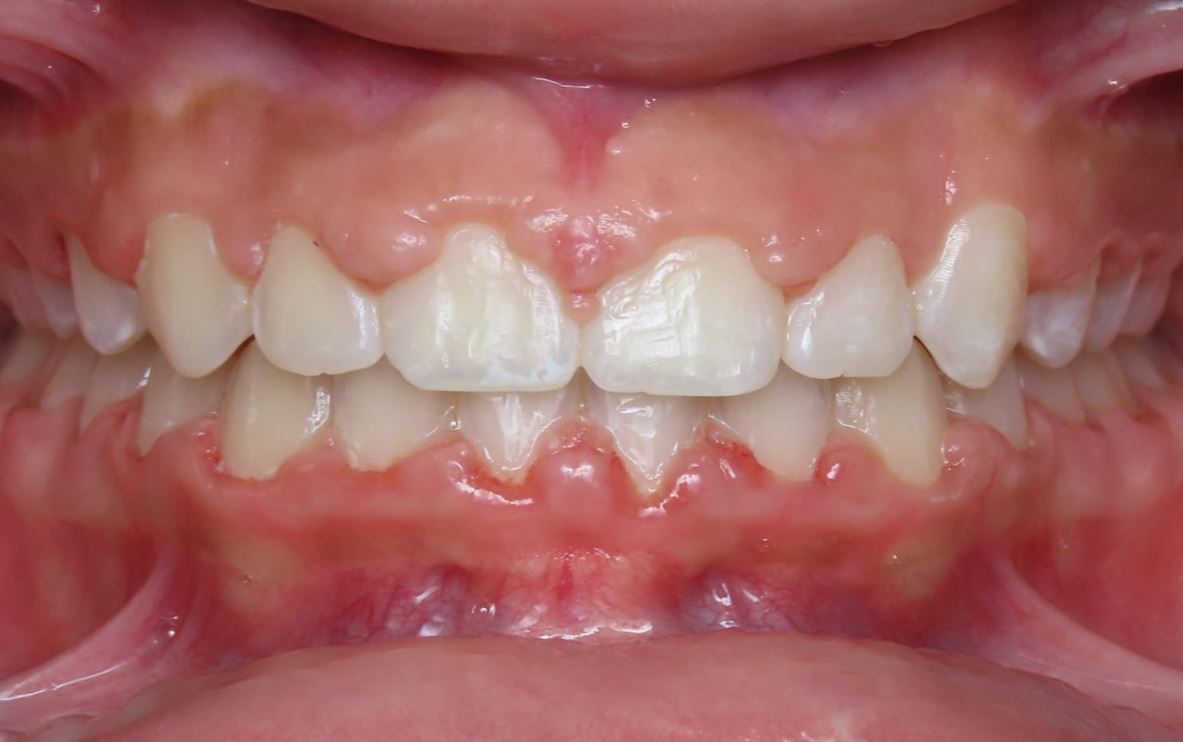 More smile transformations 165 Patient smile transformation results allysa center final
