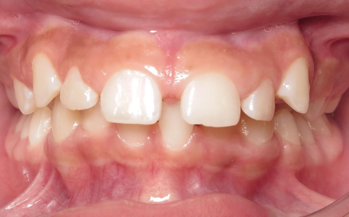 More smile transformations 164 Alyssa center start