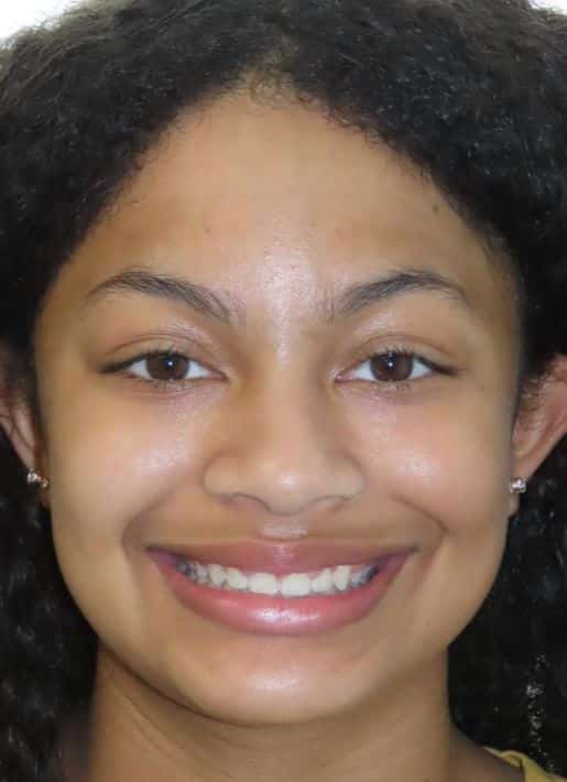 More smile transformations 167 Jfo patient before orthodontic treatment alyssa smile final