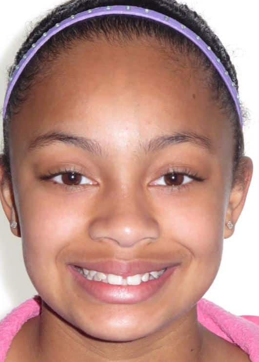 More smile transformations 166 Jfo patient before orthodontic treatment alyssa smile start