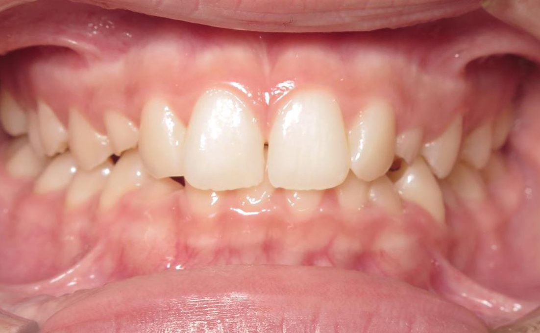 More smile transformations 293 Jfo smile gallery caitlyn center before