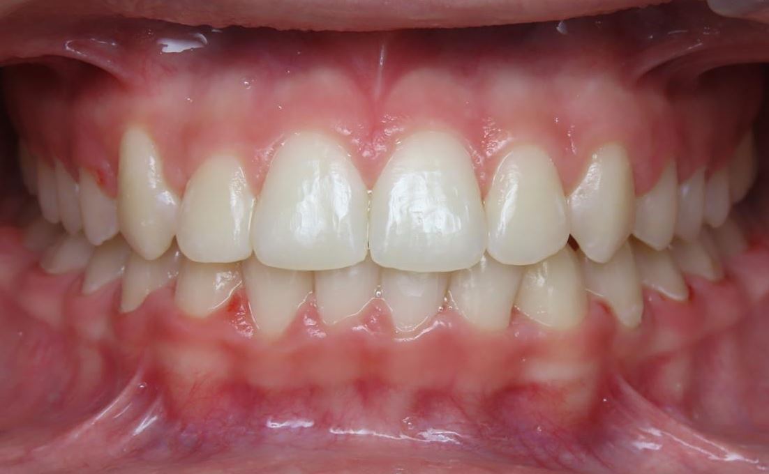 More smile transformations 294 Jfo smile gallery caitlyn center after