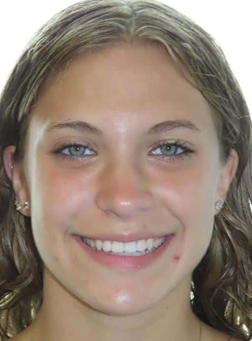 More smile transformations 292 Jfo smile gallery caitlyn center full face final