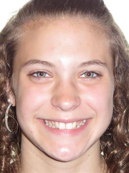 More smile transformations 291 Jfo smile gallery caitlyn center full face before