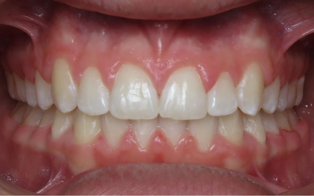 More smile transformations 161 Jfo smile gallery christiano center final