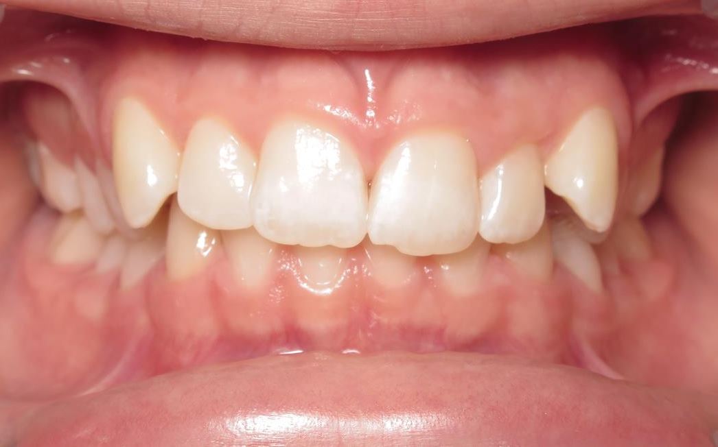 More smile transformations 160 Jfo smile gallery christiano center before