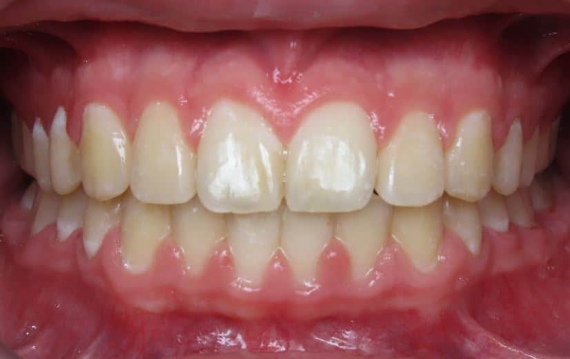 More smile transformations 147 Jfo smile gallery ethan smile center final