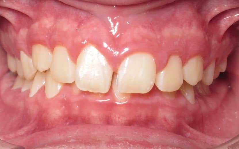 More smile transformations 146 Jfo smile gallery ethan smile center start