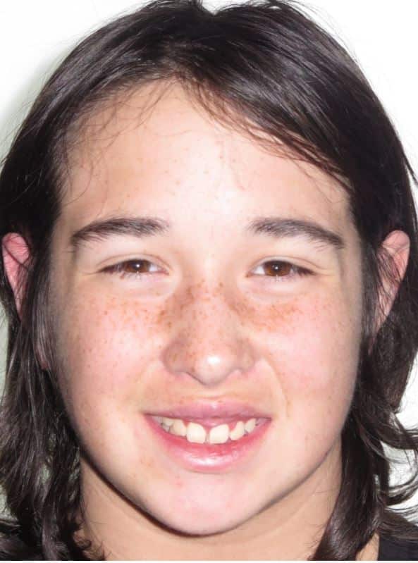 More smile transformations 144 Jfo smile gallery ethan smile start