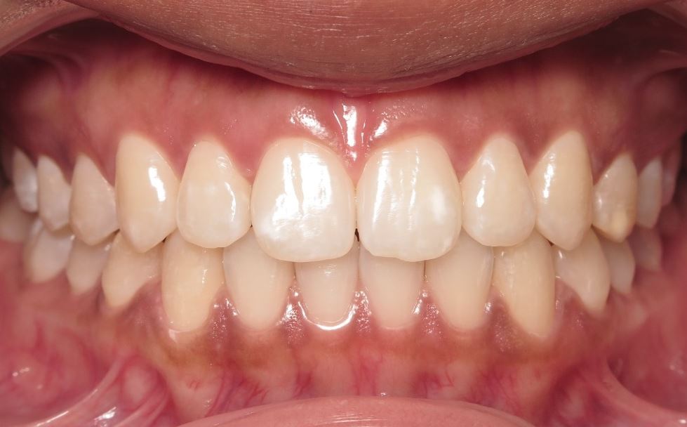 More smile transformations 153 Jfo smile gallery vera smile center final