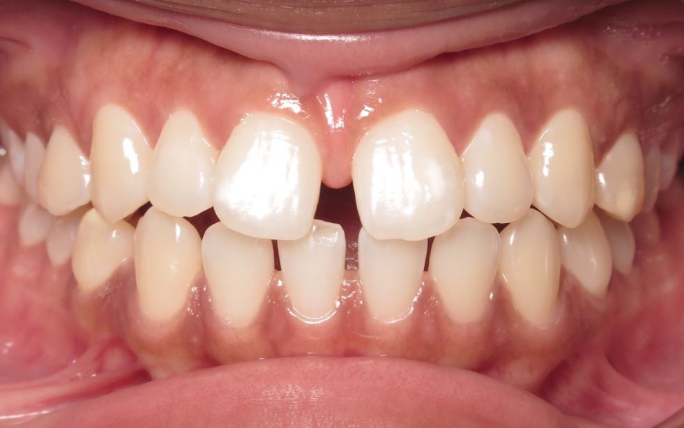 More smile transformations 152 Jfo smile gallery vera smile center start