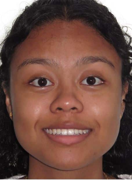 More smile transformations 155 Jfo smile gallery vera smile full face final