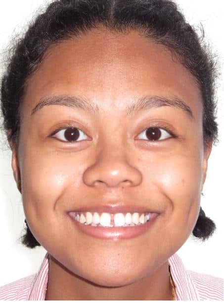 More smile transformations 154 Jfo smile gallery vera smile full face start