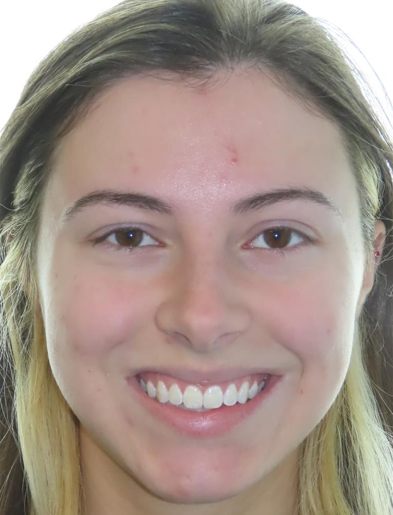 More smile transformations 129 Jfo smile gallery a smile full face final