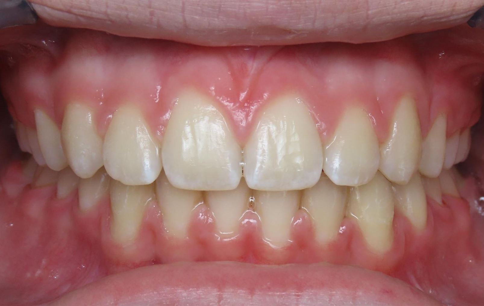 More smile transformations 135 Jfo smile gallery et smile full face center end