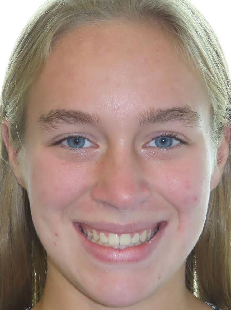 More smile transformations 139 Jfo smile gallery gs smile full face finish