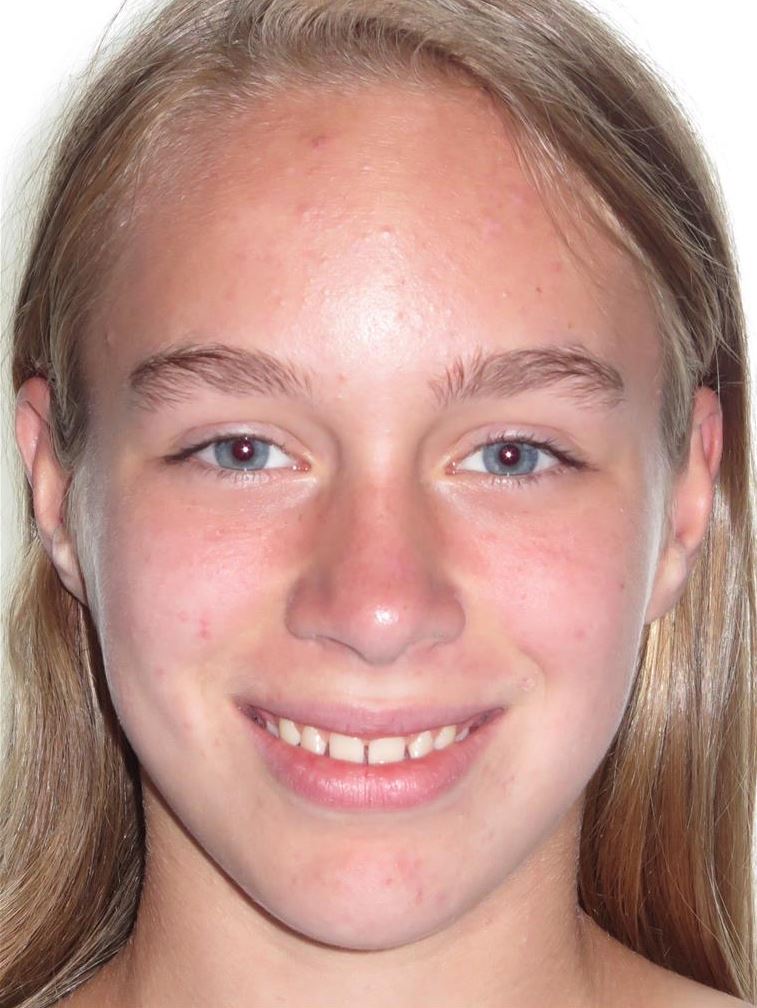 More smile transformations 138 Jfo smile gallery gs smile full face start