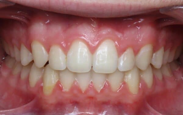 More smile transformations 133 Jfo smile gallery l smile center finish