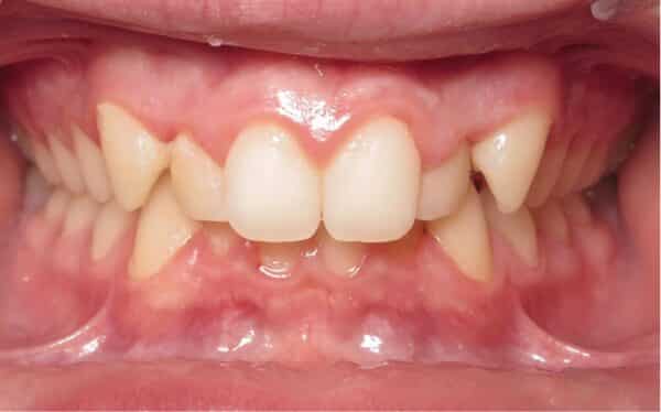 More smile transformations 132 Jfo smile gallery l smile center start