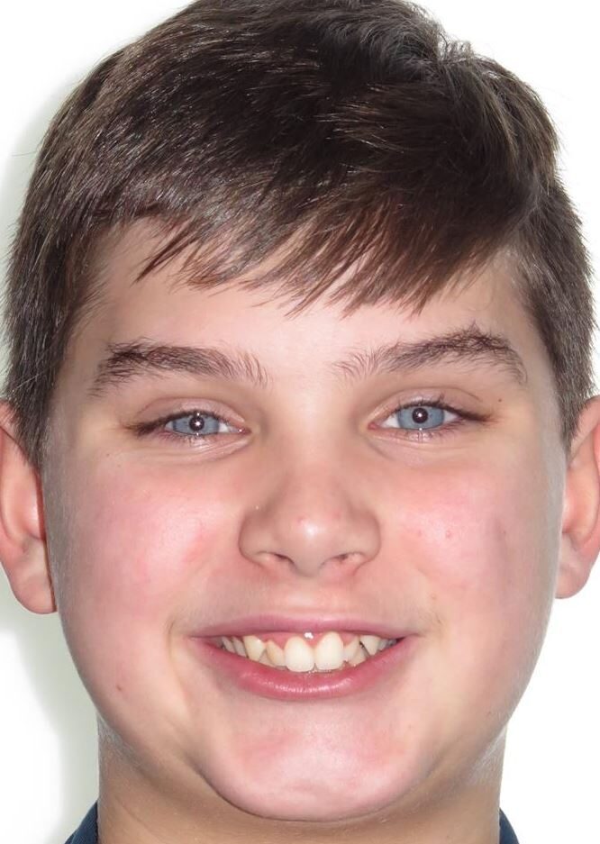 More smile transformations 130 Jfo smile gallery l smile full face start