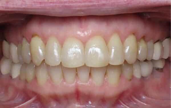 More smile transformations 141 Jfo smile gallery rc smile center finish