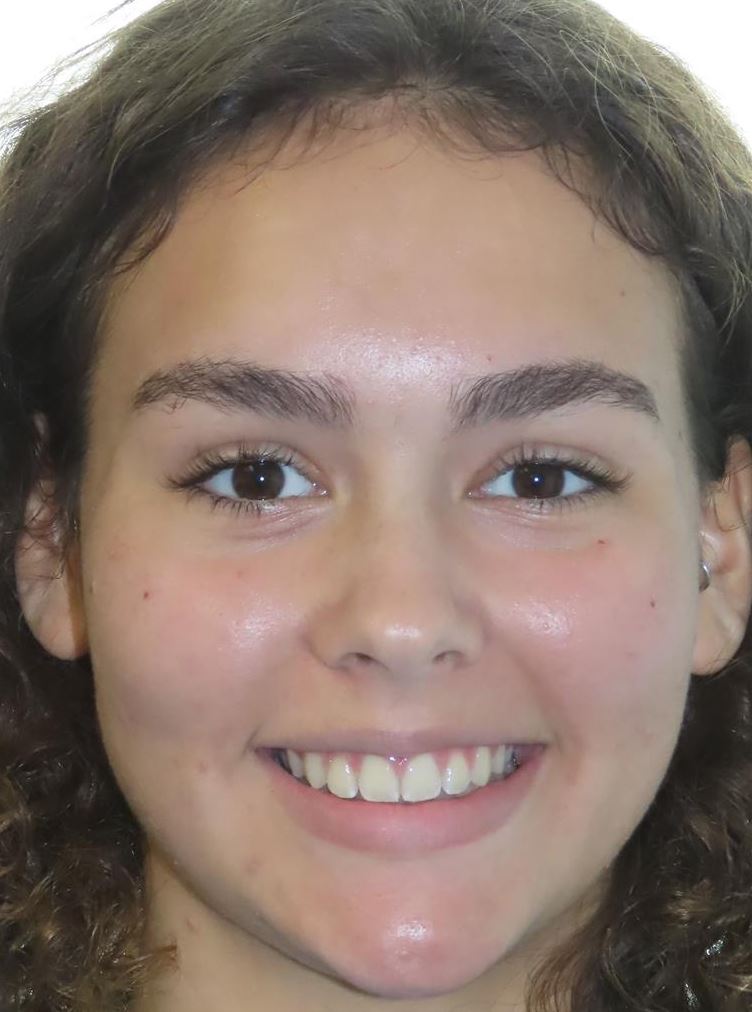 More smile transformations 137 Jfo smile gallery et smile full face finish