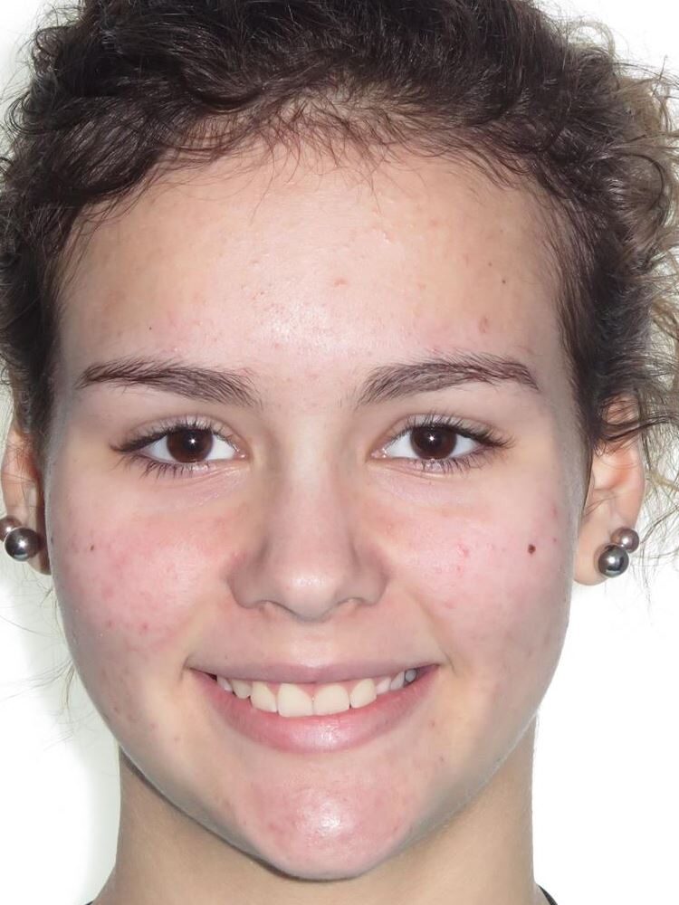 More smile transformations 136 Jfo smile gallery et smile full face start