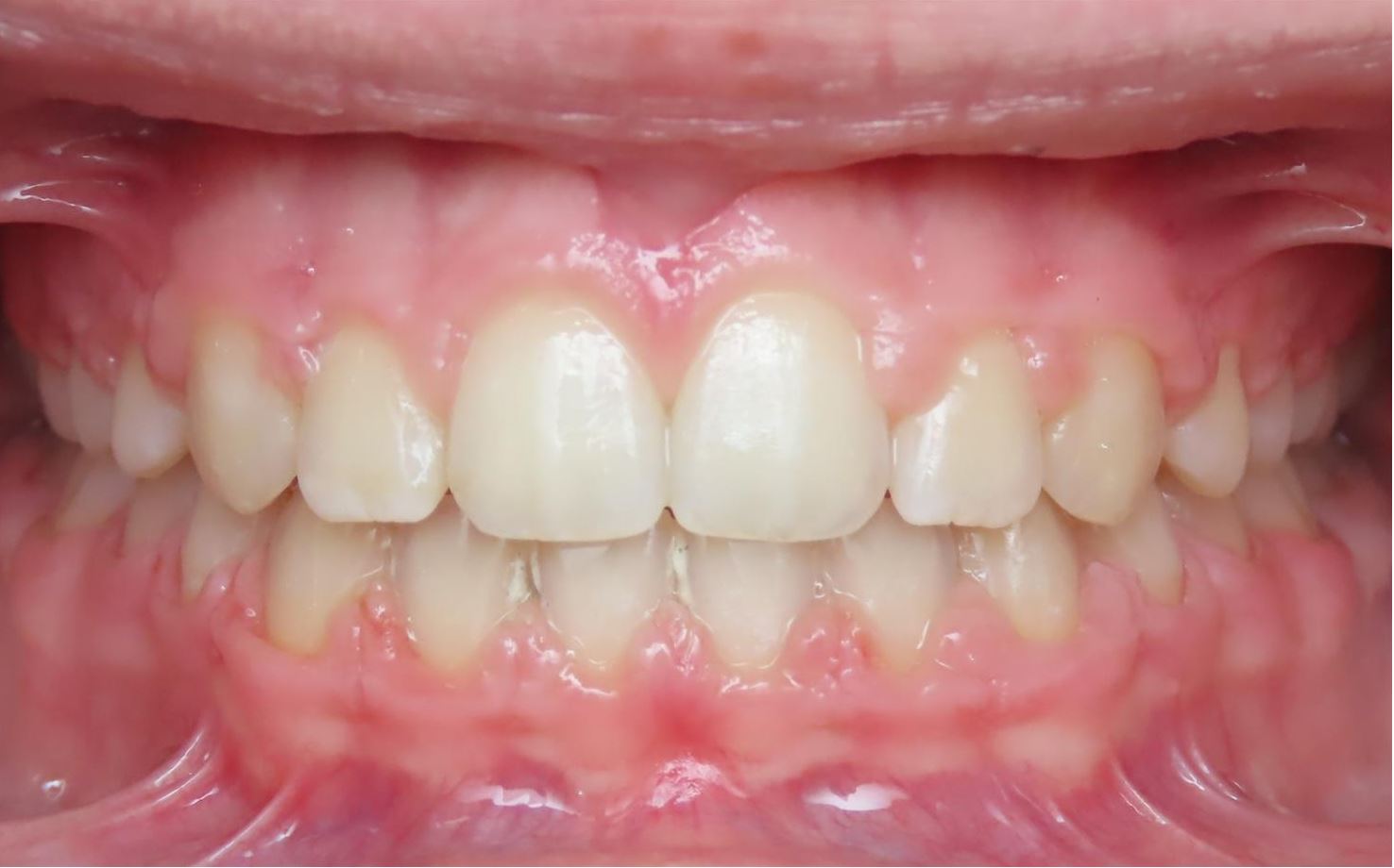 More smile transformations 123 Jfo smile gallery ella smile center final