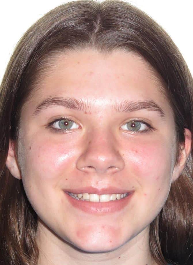 More smile transformations 124 Jfo smile gallery ella smile full face after