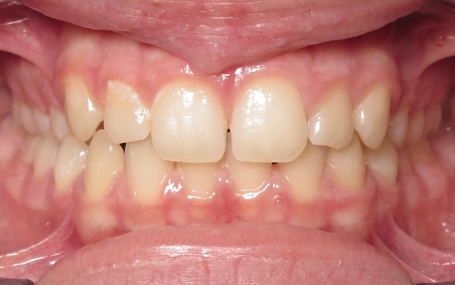 More smile transformations 122 Jfo smile gallery ella smile center start