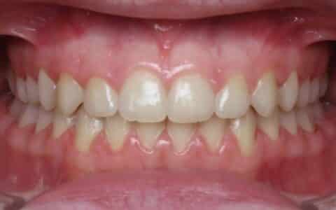 More smile transformations 115 Jfo smile gallery cameron smile center final