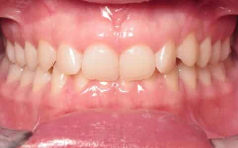 More smile transformations 114 Jfo smile gallery cameron smile center start