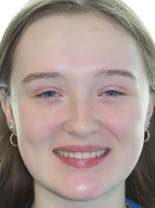 More smile transformations 117 Jfo smile gallery cameron smile full face final