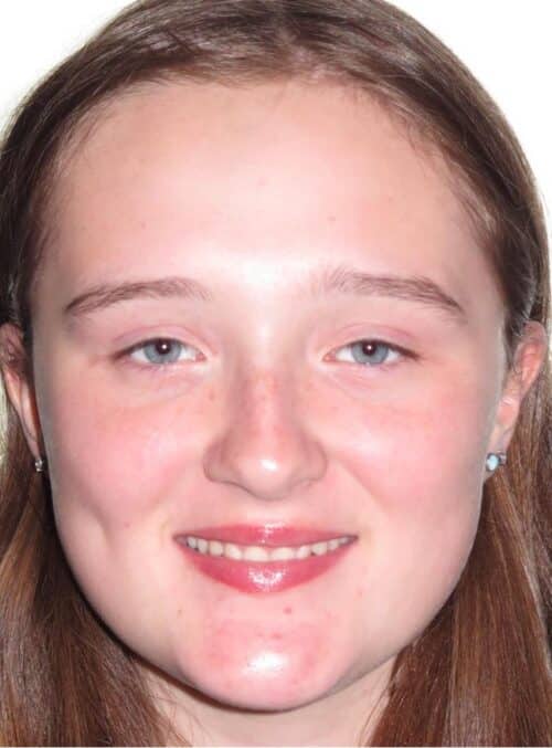 More smile transformations 116 Jfo smile gallery cameron smile full face start