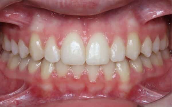 More smile transformations 121 Jfo smile gallery katelyn smile center final