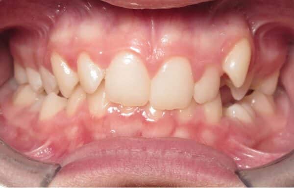 More smile transformations 120 Jfo smile gallery katelyn smile center start