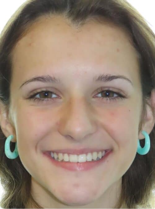 More smile transformations 119 Jfo smile gallery katelyn smile full face final