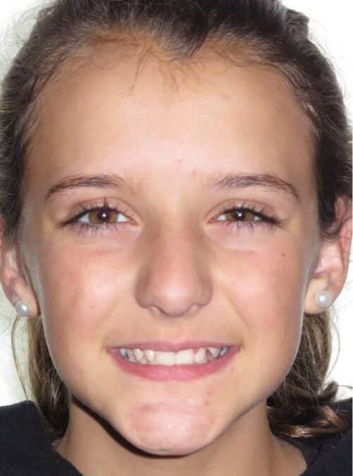 More smile transformations 118 Jfo smile gallery katelyn smile full face start