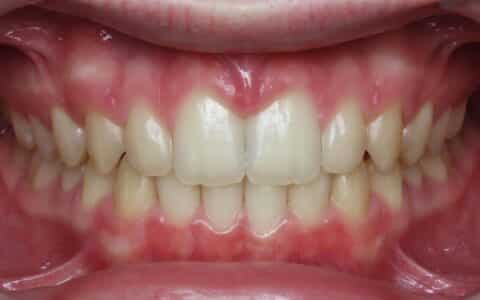 More smile transformations 113 Jfo smile gallery luke smile center final