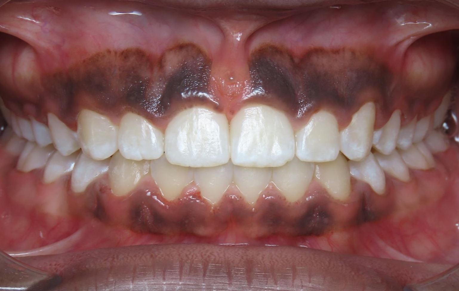 More smile transformations 103 Jfo smile gallery alona smile center final