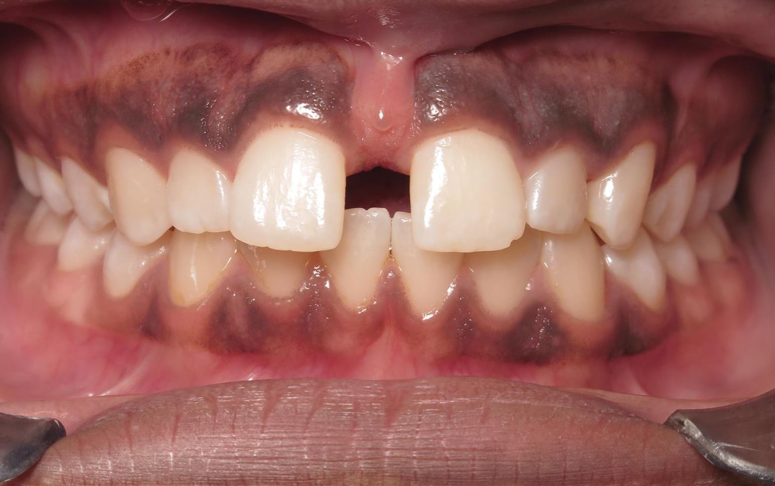 More smile transformations 102 Jfo smile gallery alona smile center start