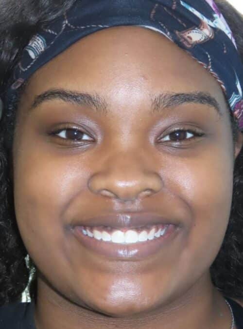 More smile transformations 101 Jfo smile gallery alona smile full face final
