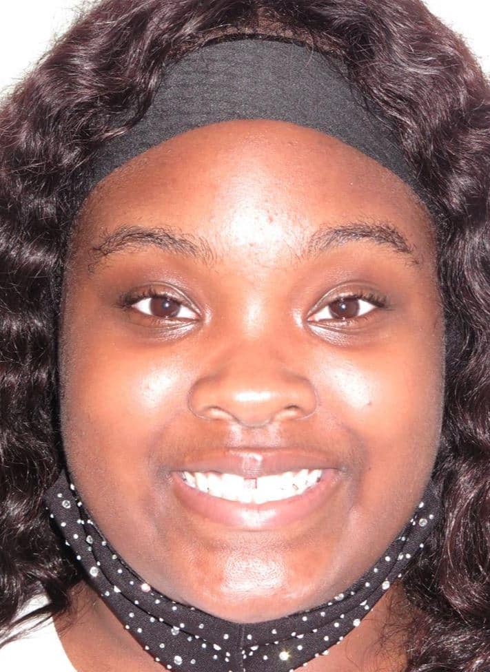 More smile transformations 100 Jfo smile gallery alona smile full face start