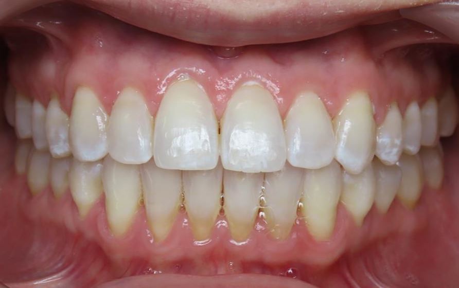More smile transformations 95 Jfo smile gallery jennifer center final