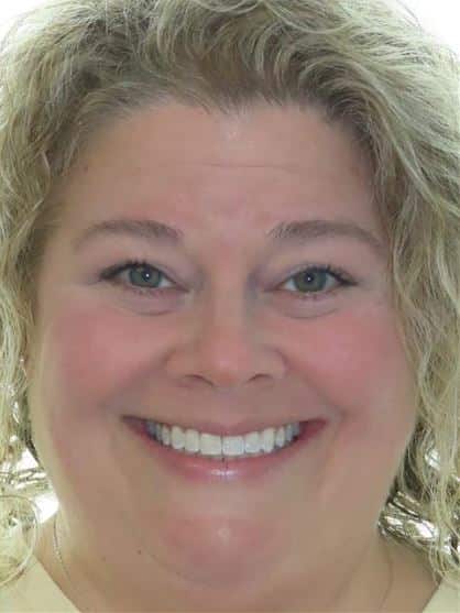 More smile transformations 93 Jfo smile gallery jennifer full face final