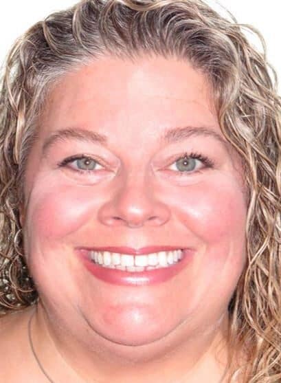 More smile transformations 92 Jfo smile gallery jennifer full face start