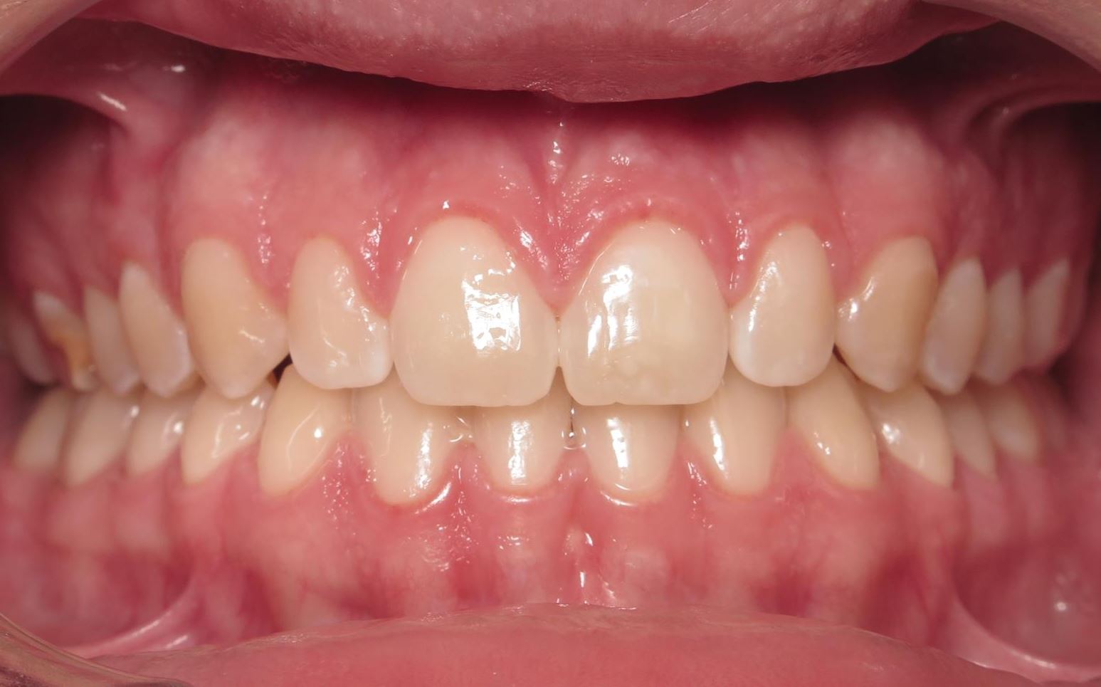 More smile transformations 97 Jfo smile gallery ryan smile ryan center final