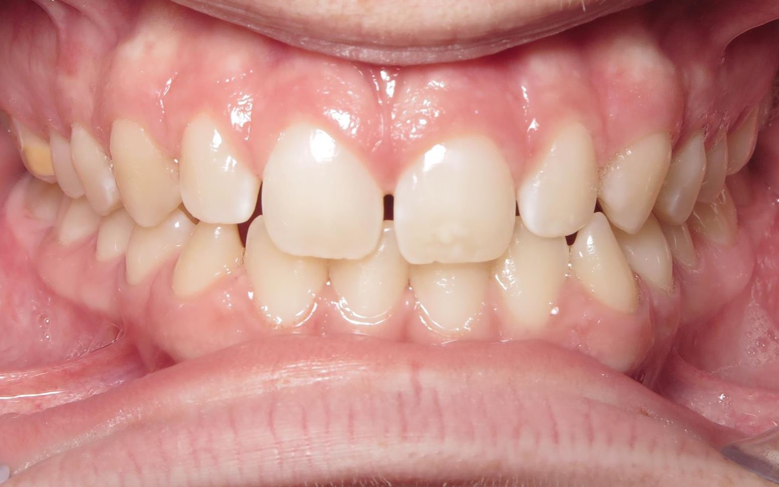 More smile transformations 96 Jfo smile gallery ryan smile ryan center start