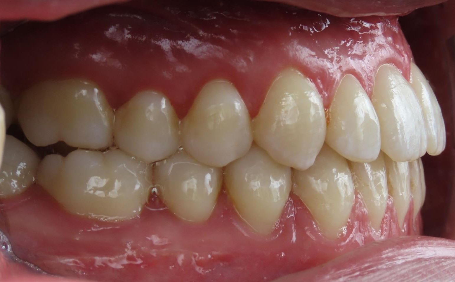 More smile transformations 105 Jfo smile gallery smile r buccal final
